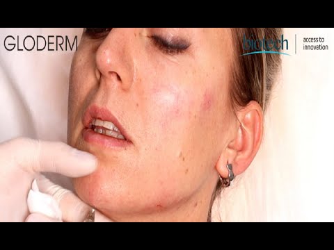 Gloderm | Chin Augmentation Experienc