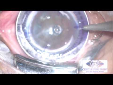 Eyecryl TORIC Live Surgery by Dr  Gaurav Mishra DOS 2017