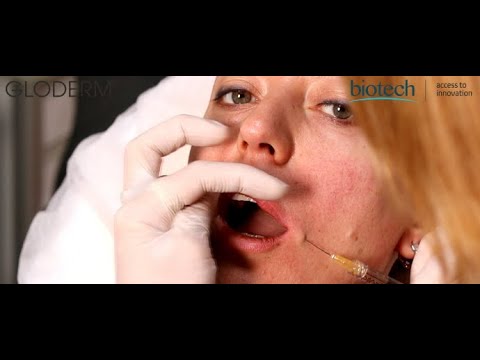 Gloderm | Lip Augmentation