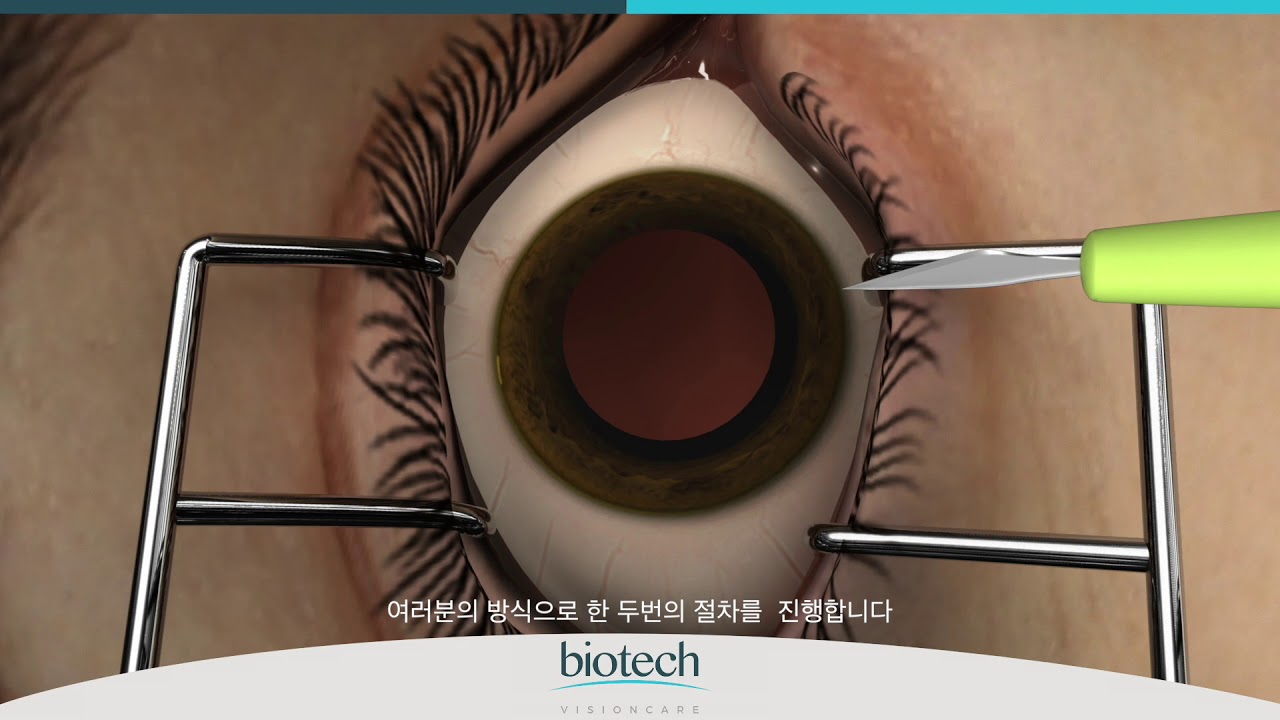 Optiflex GLAZE Range Loading & Implantation in Korean