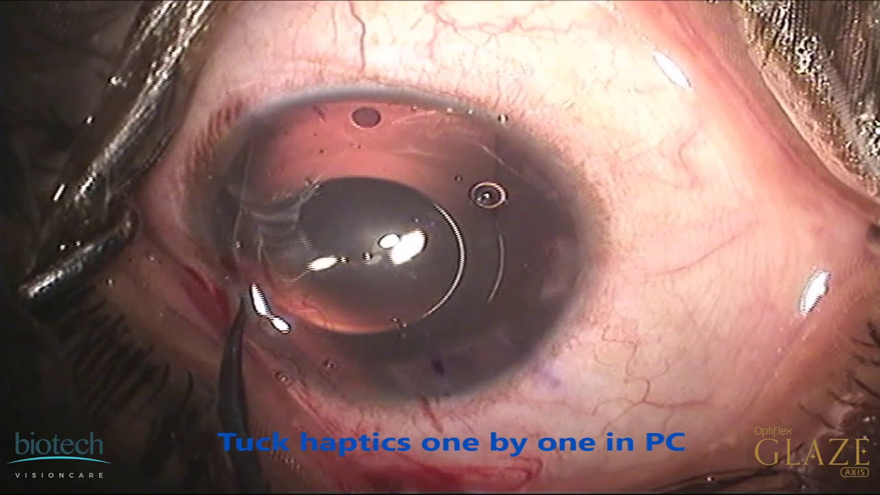 Optiflex GLAZE AXIS Surgery Video