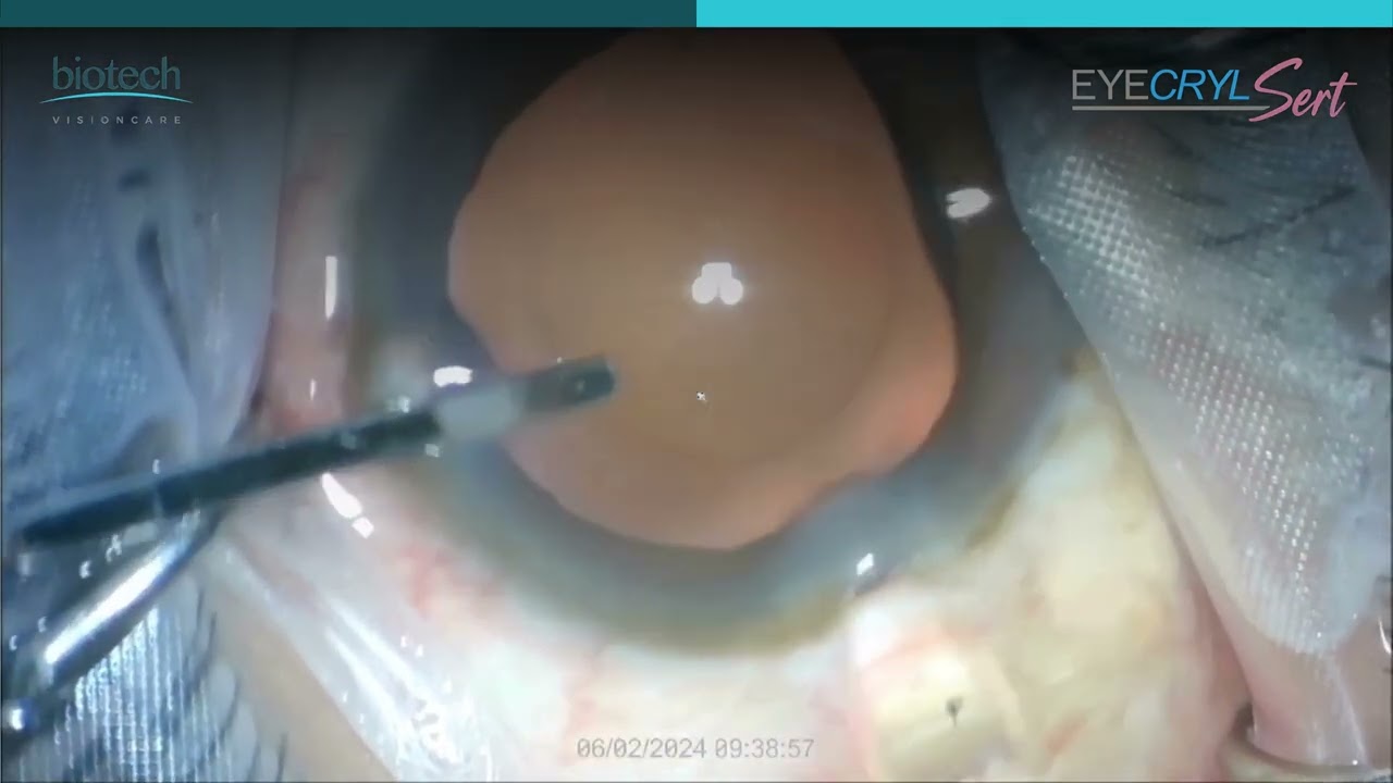 EYECRYL SERT WITH BSS