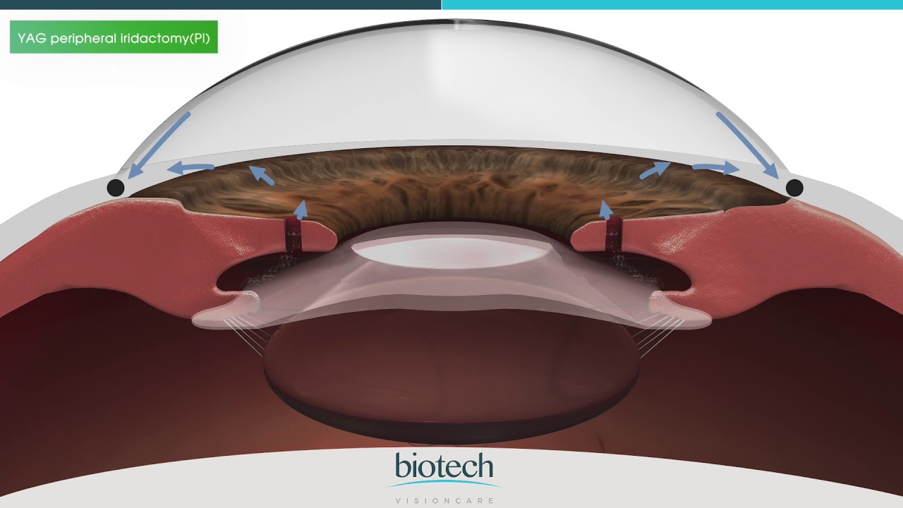 Optiflex GLAZE Range Role of Central Hole in Korean