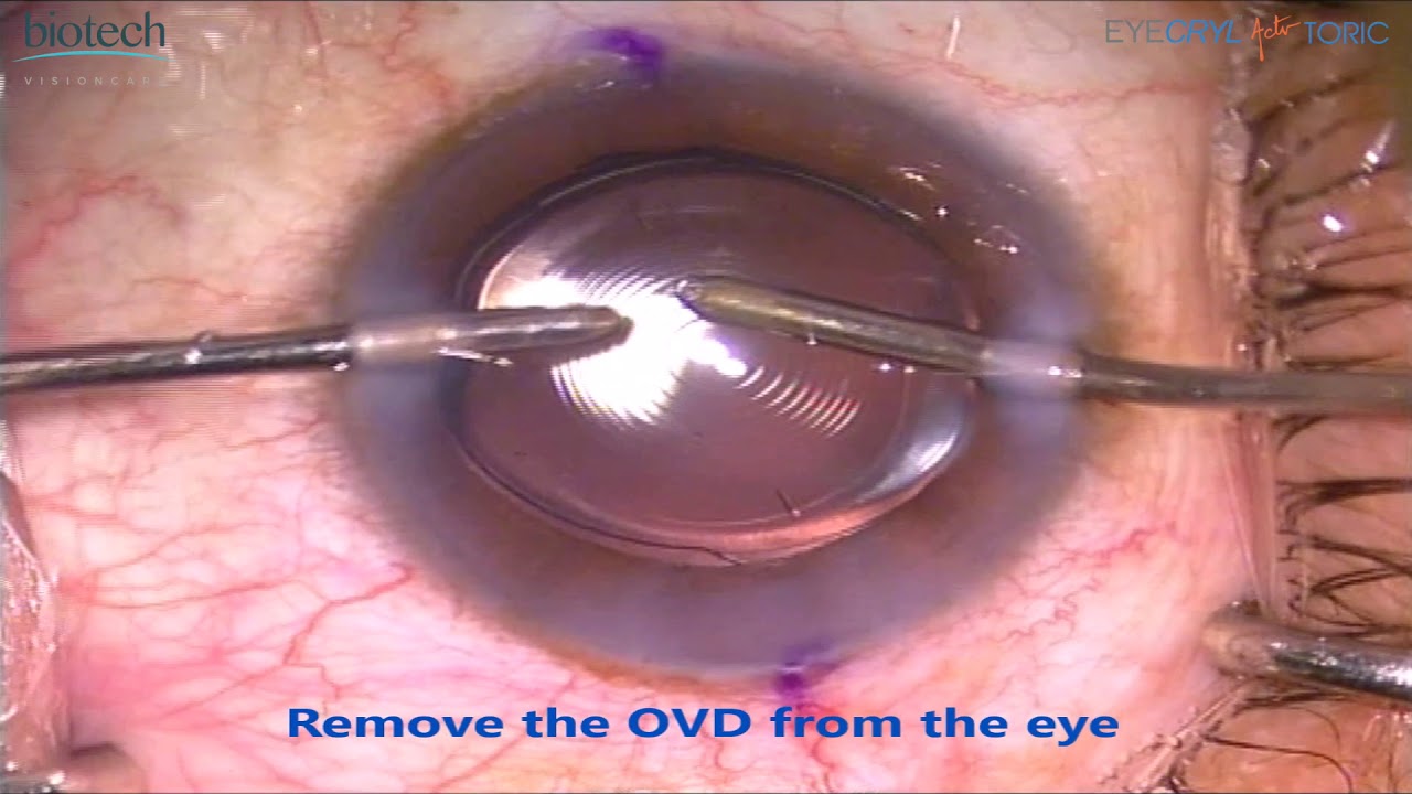 EYECRYL Actv TORIC