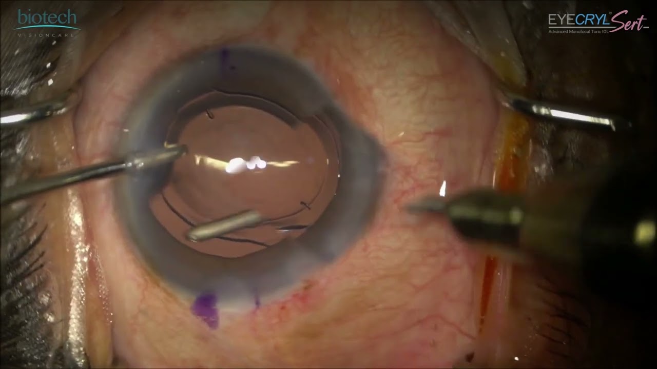 Eyecryl SERT Toric | Surgery video with explanation