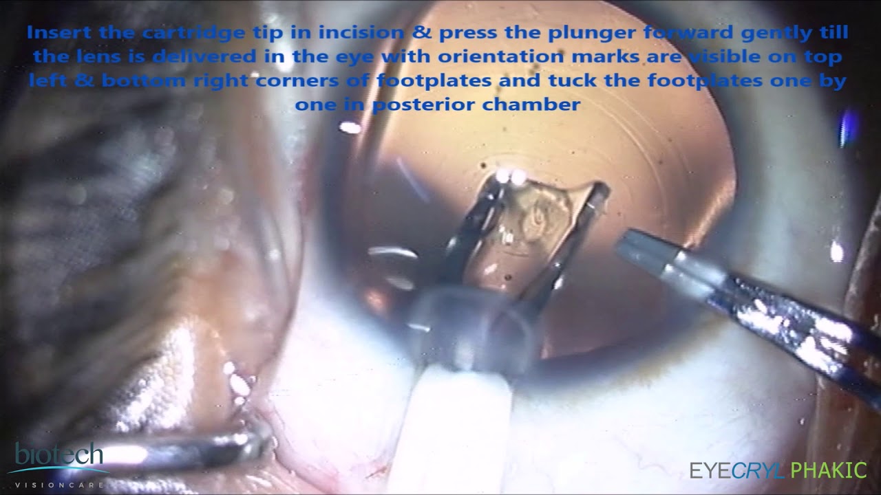 EYECRYL PHAKIC