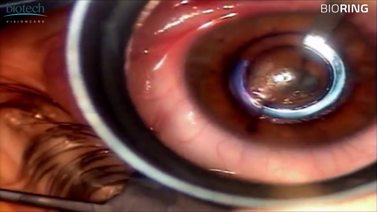 BioRingHDvideo