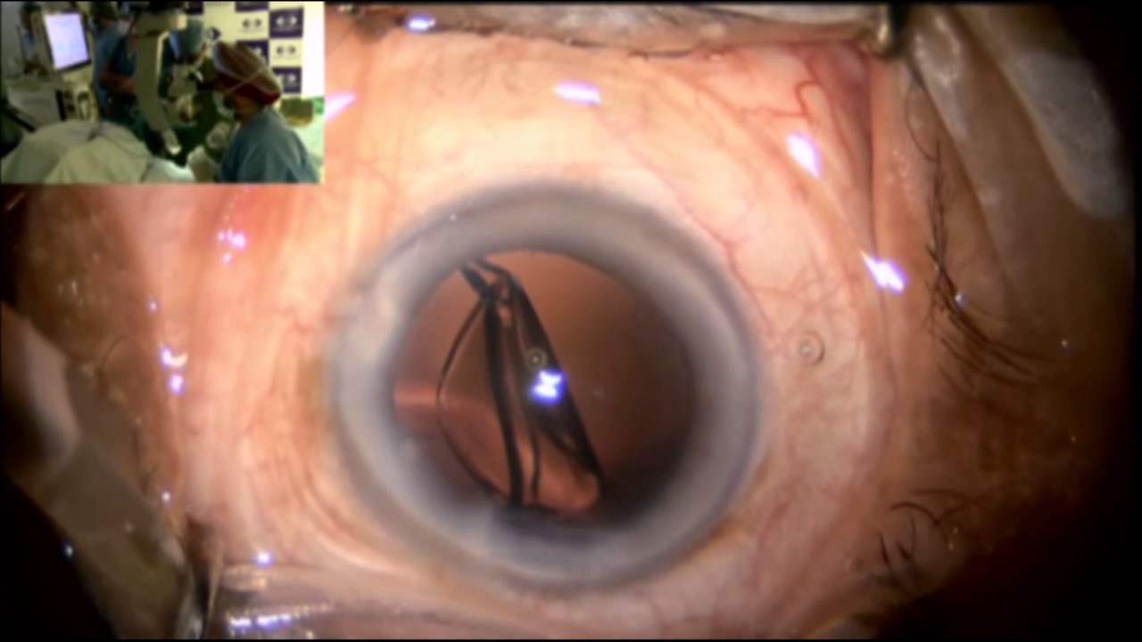 Eyecryl ACTV Live Surgery by Dr  Mahipal Sachdev at DOS 2017
