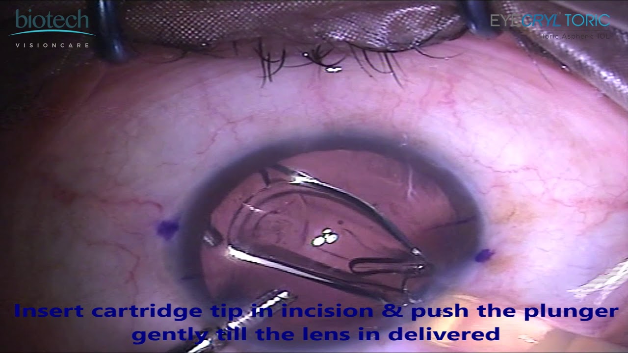 EYECRYL TORIC