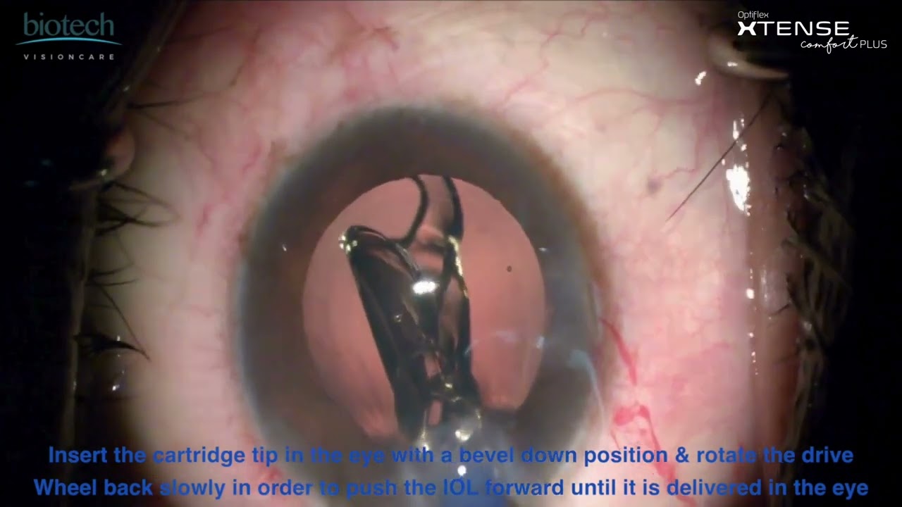 OPTIFLEX XTENSE COMFORT PLUS Surgery Video