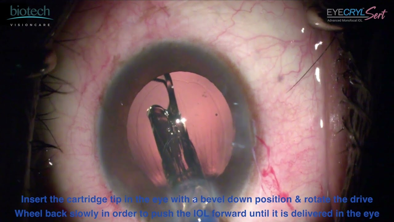 Eyecryl SERT PLHFD6 | Surgery video with explanation.