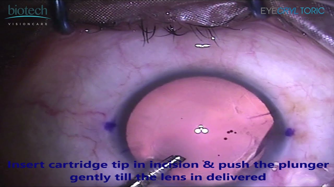 EYECRYL TORIC_New