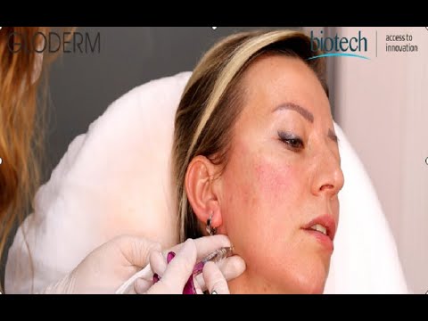 Gloderm | Jawline Augmentation