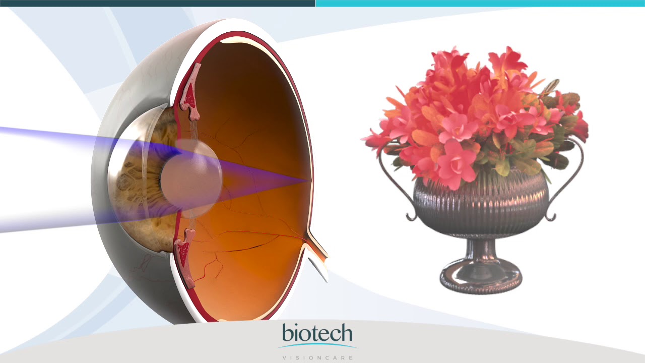 Eyecryl TORIC Patient Education Video