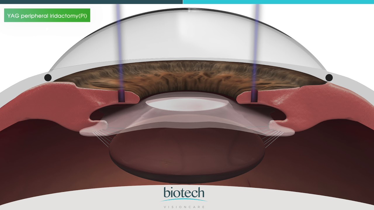 Eyecryl PHAKIC Range Role of Central Hole