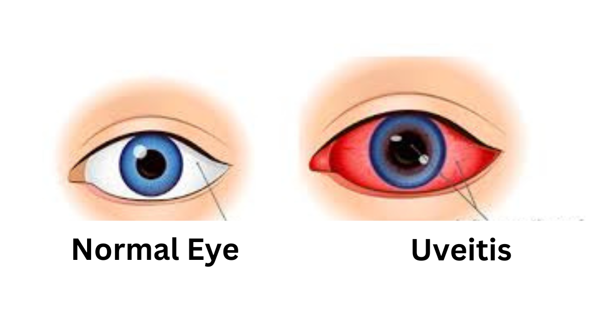 Uveitis | Symptoms, Causes, Diagnosis, Treatment