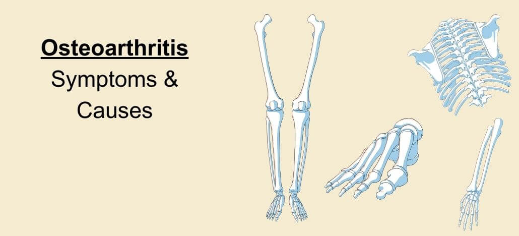 Osteoarthritis – Symptoms & Causes