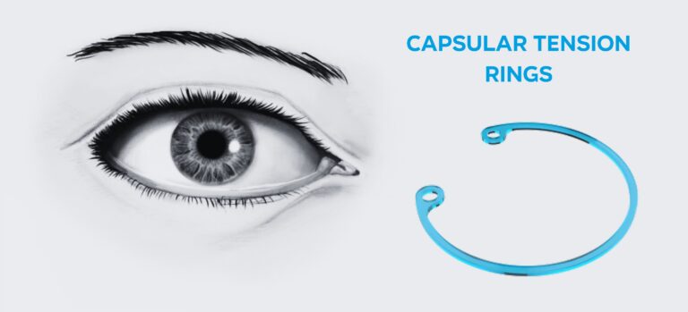 Capsular Tension Rings When To Use Them When To Refer Scaled