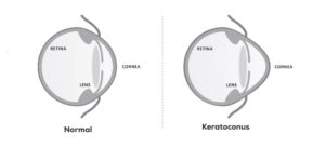 Phakic Lenses And Stable Keratoconus A Comprehensive Guide Scaled