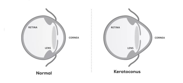 Phakic Lenses And Stable Keratoconus A Comprehensive Guide Scaled