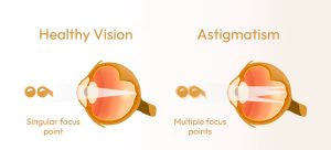 What Is Astigmatism Scaled