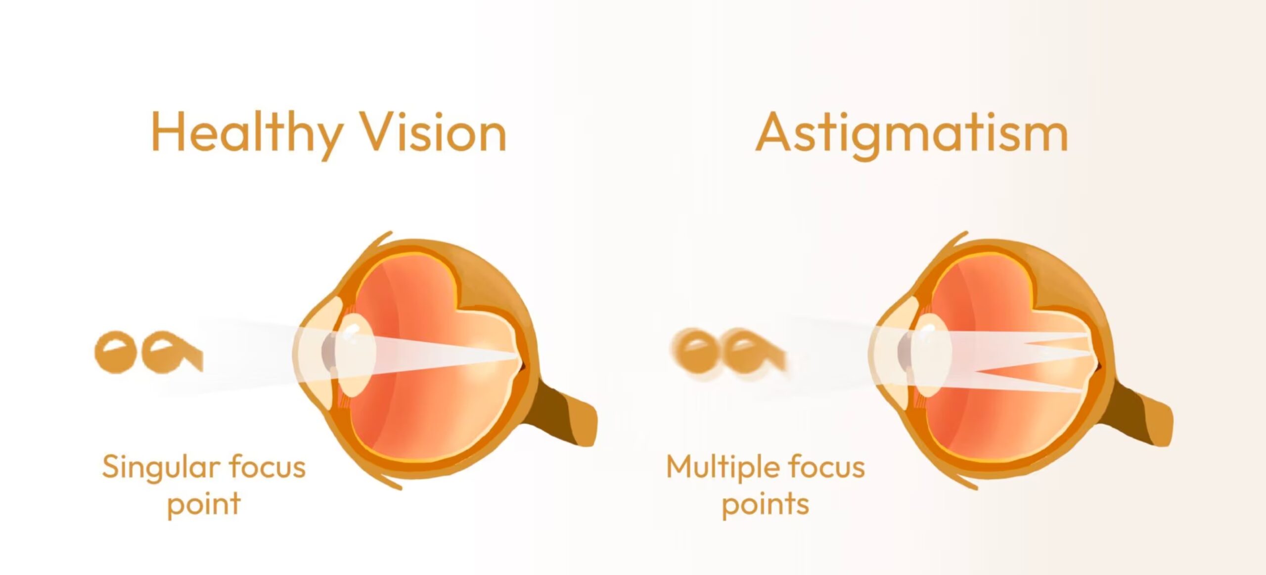 What Is Astigmatism Scaled