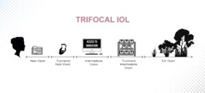 What Is A Trifocal Lens How Does It Work