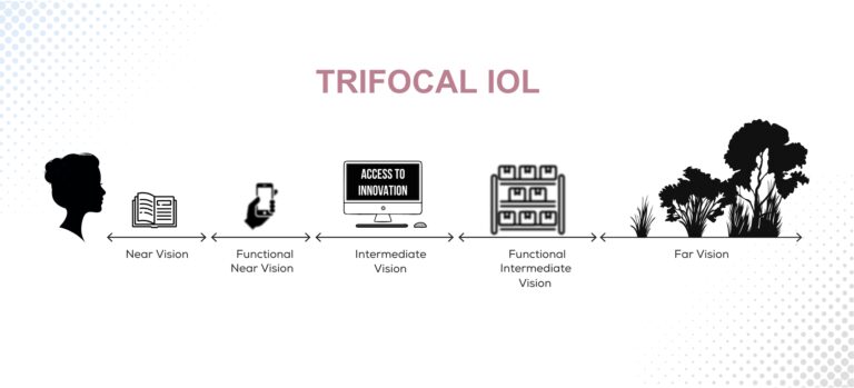 What Is A Trifocal Lens How Does It Work