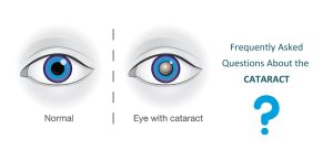 Frequently Asked Questions About Cataract