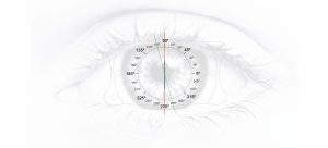 What Do Phakic Lenses Offer When Astigmatism + Myopia Come Together