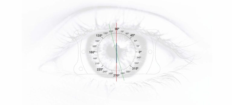 What Do Phakic Lenses Offer When Astigmatism + Myopia Come Together