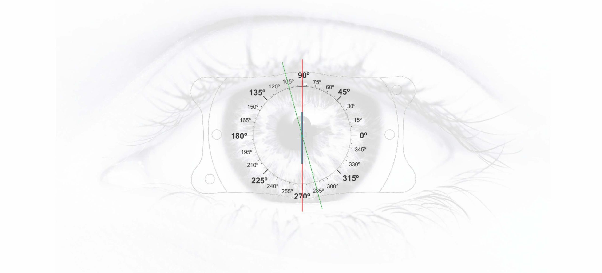 What Do Phakic Lenses Offer When Astigmatism + Myopia Come Together