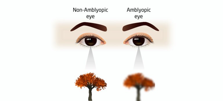 Do Phakic Lenses Work in Eyes with Lazy Eye (Amblyopia) 1