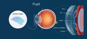 Front or Back of the Iris Different Phakic Lens Types and Their Placement Areas 1