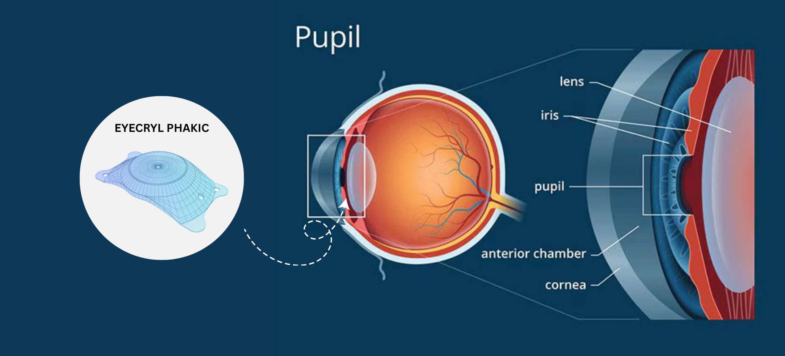 Front or Back of the Iris Different Phakic Lens Types and Their Placement Areas 1
