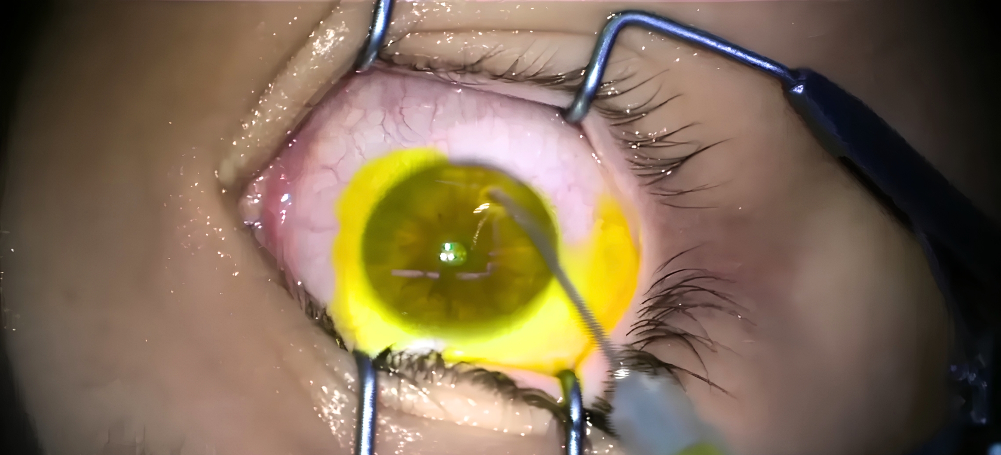 Managing Thin Corneas in CXL Accelerated Protocols, Hypoosmolar Riboflavin and Trans epithelial Approaches